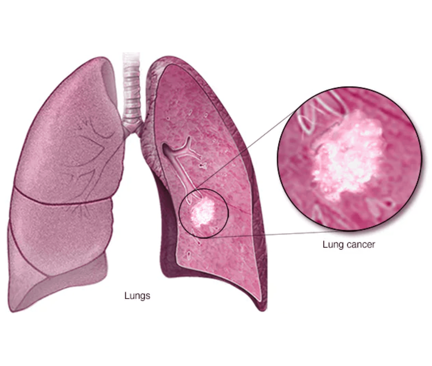 Lung Cancer care at Agastya Oncology