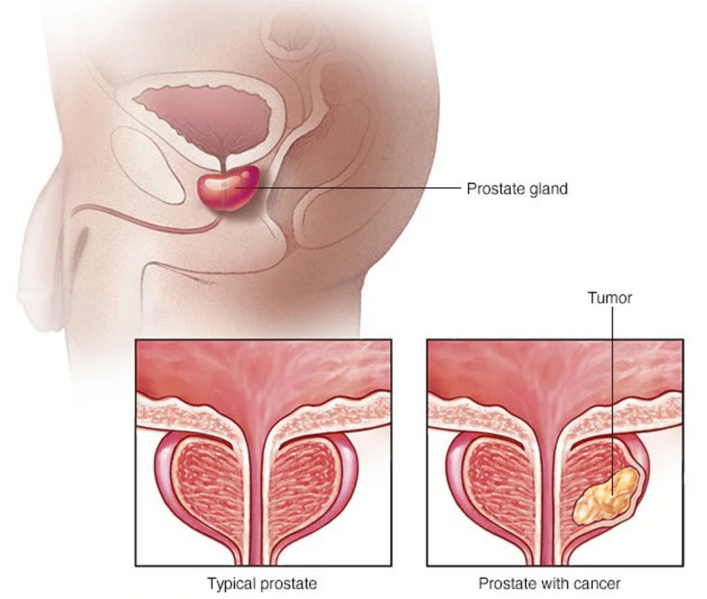 Prostate Cancer care at Agastya Oncology