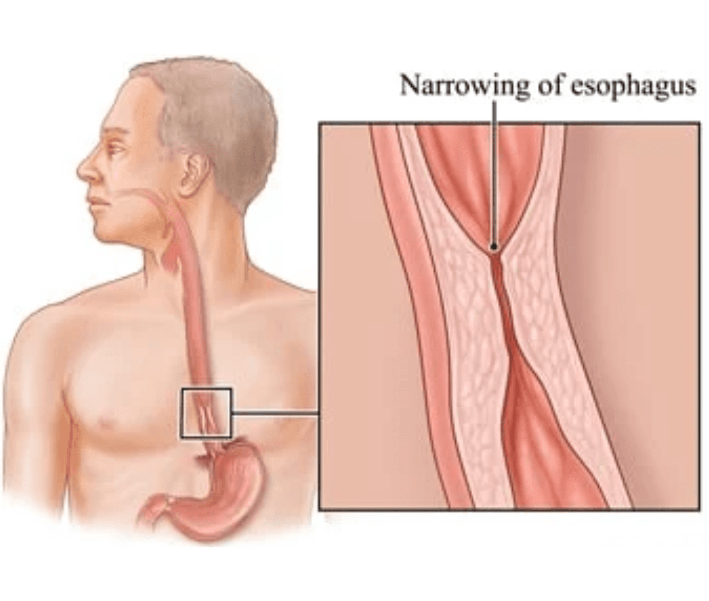 Stomach & Esophageal Cancer care at Agastya Oncology